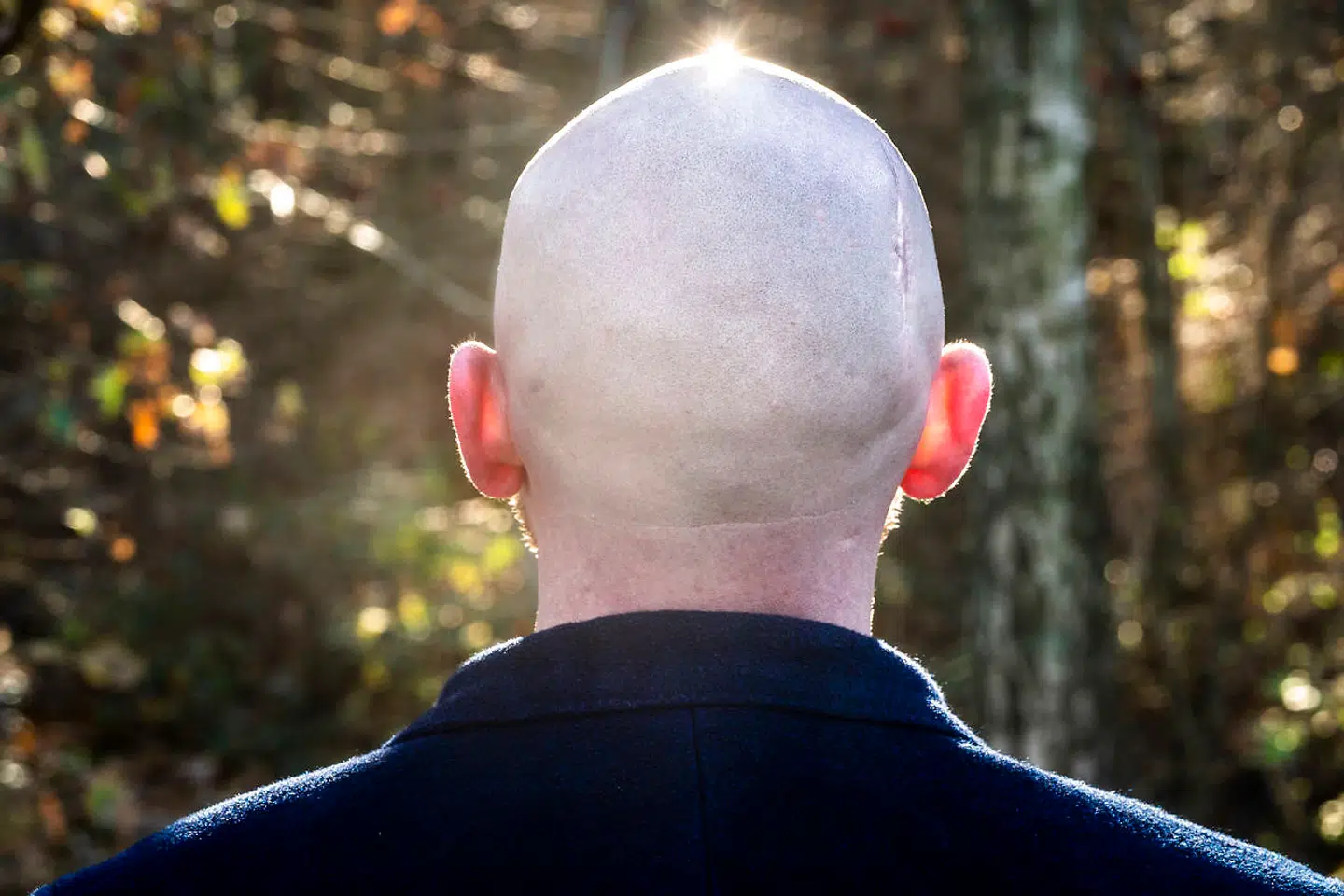 Det er omkring to år siden, at Mark Le Fêvre fik en temmelig stor forskrækkelse, efter han havde fået fjernet et modermærke på hovedet. Modermærket viste tegn på kræft, og lægerne blev nødt til at skære et stort stykke hud af hans hoved for at fastlægge, om der var kræft eller ej - han klarede »frisag«.