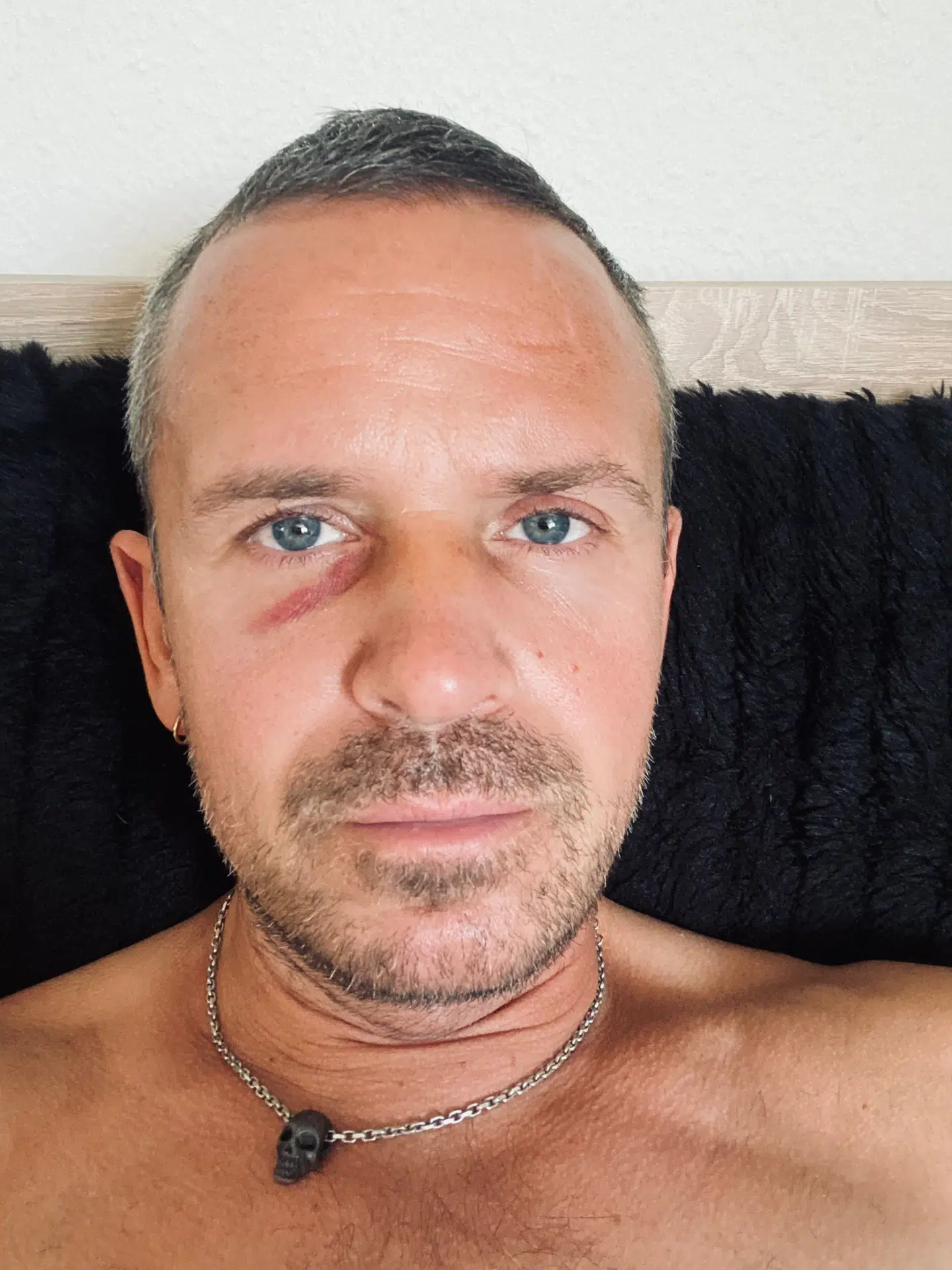 Simon Witzansky tre dage efter han blev slået i ansigtet med en knytnæve under WorldPride på Rådhuspladsen.