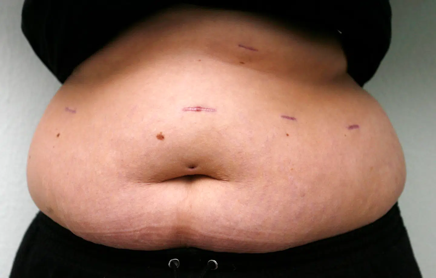 Risikoen for at blive arbejdsløs er 25 procent højere for svært overvægtige personer.