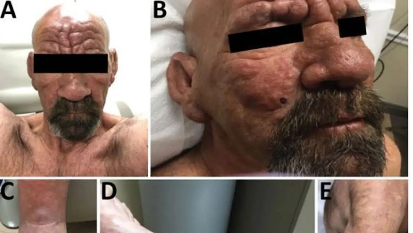 En 54-årig mand fra Florida blev diagnosticeret med spedalskhed i 2022.