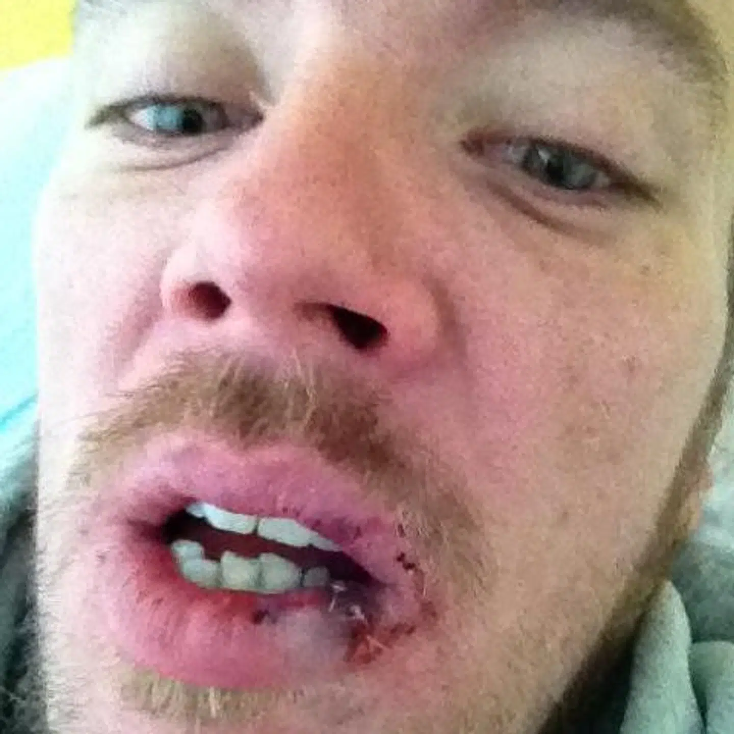 Da Nicolaj Odgaard blev overfaldet i 2002, gik det hårdt ud over hans tænder. Overfaldet skulle vise sig ikke være det sidste af sin slags.