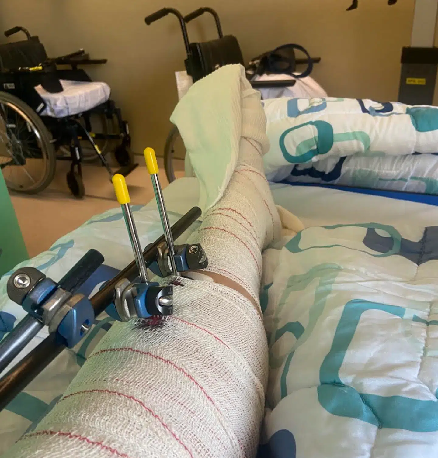 Her ses Heidi Fallesens ene ben, der blev voldsomt skadet, da hun styrtede efter et skub fra en ukendt person.