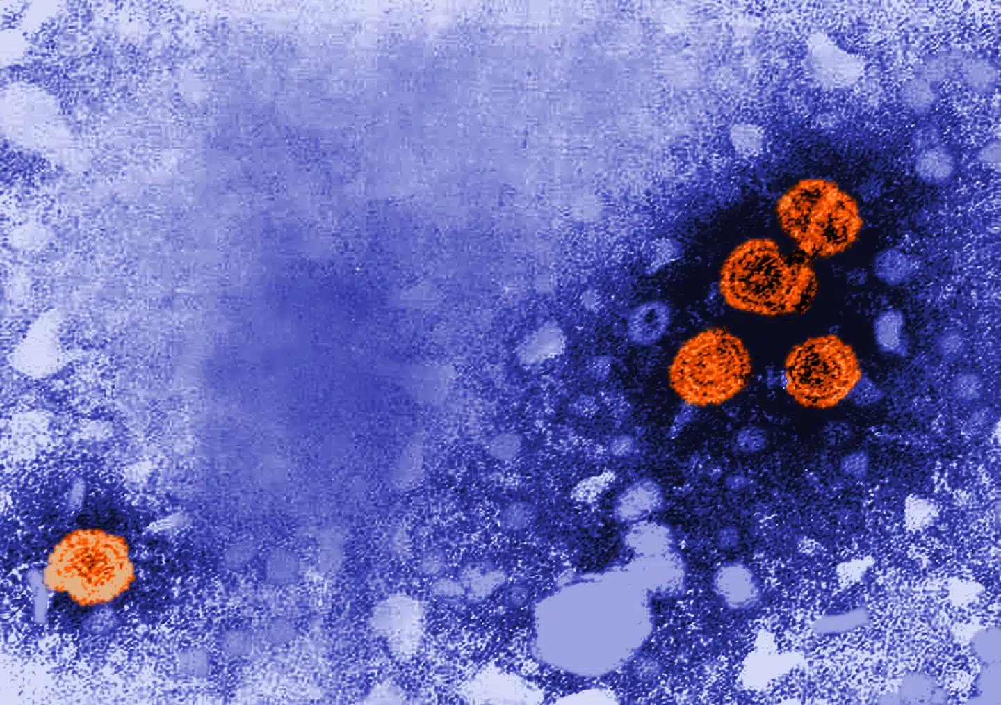De orange cirkler er Hepatitis B-virus. Foto: CDC, Dr. Erskine Palmer