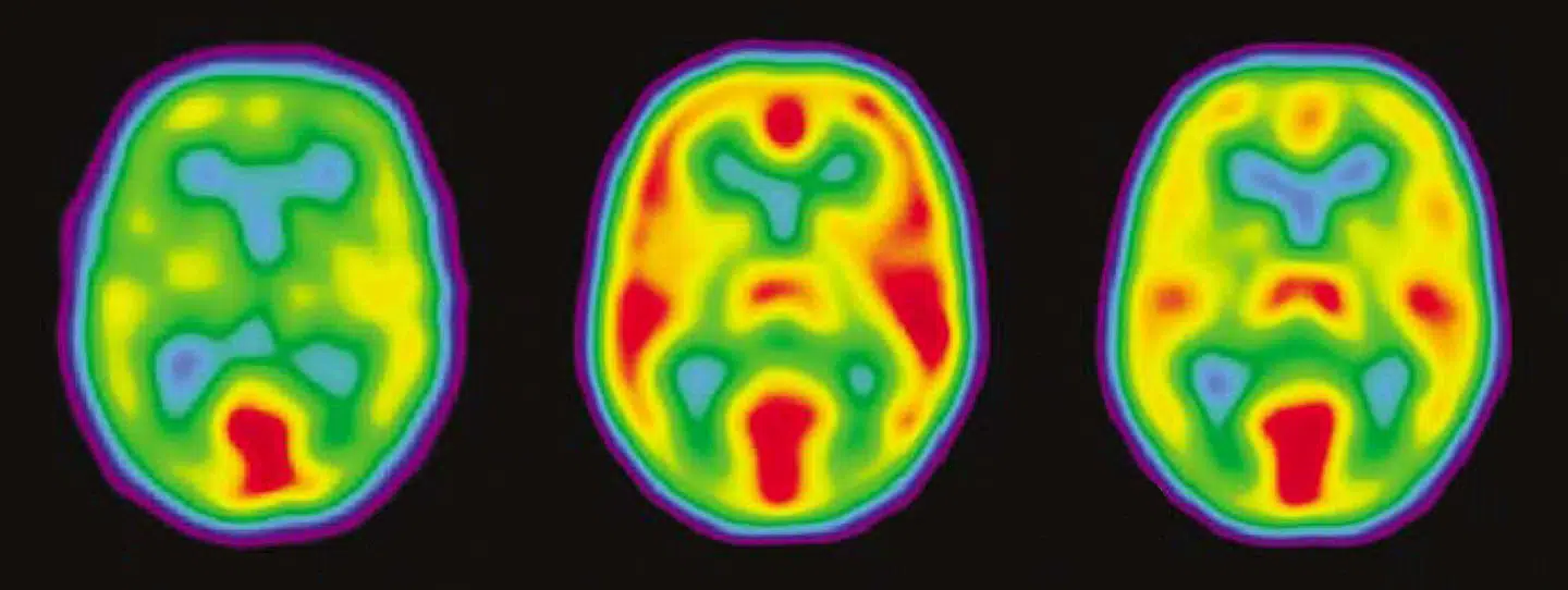 Teknikken fMRI måler aktivering af hjerneregioner, men gentagne forsøg giver forskellige resultater. Foto: Gjedde et. Al.