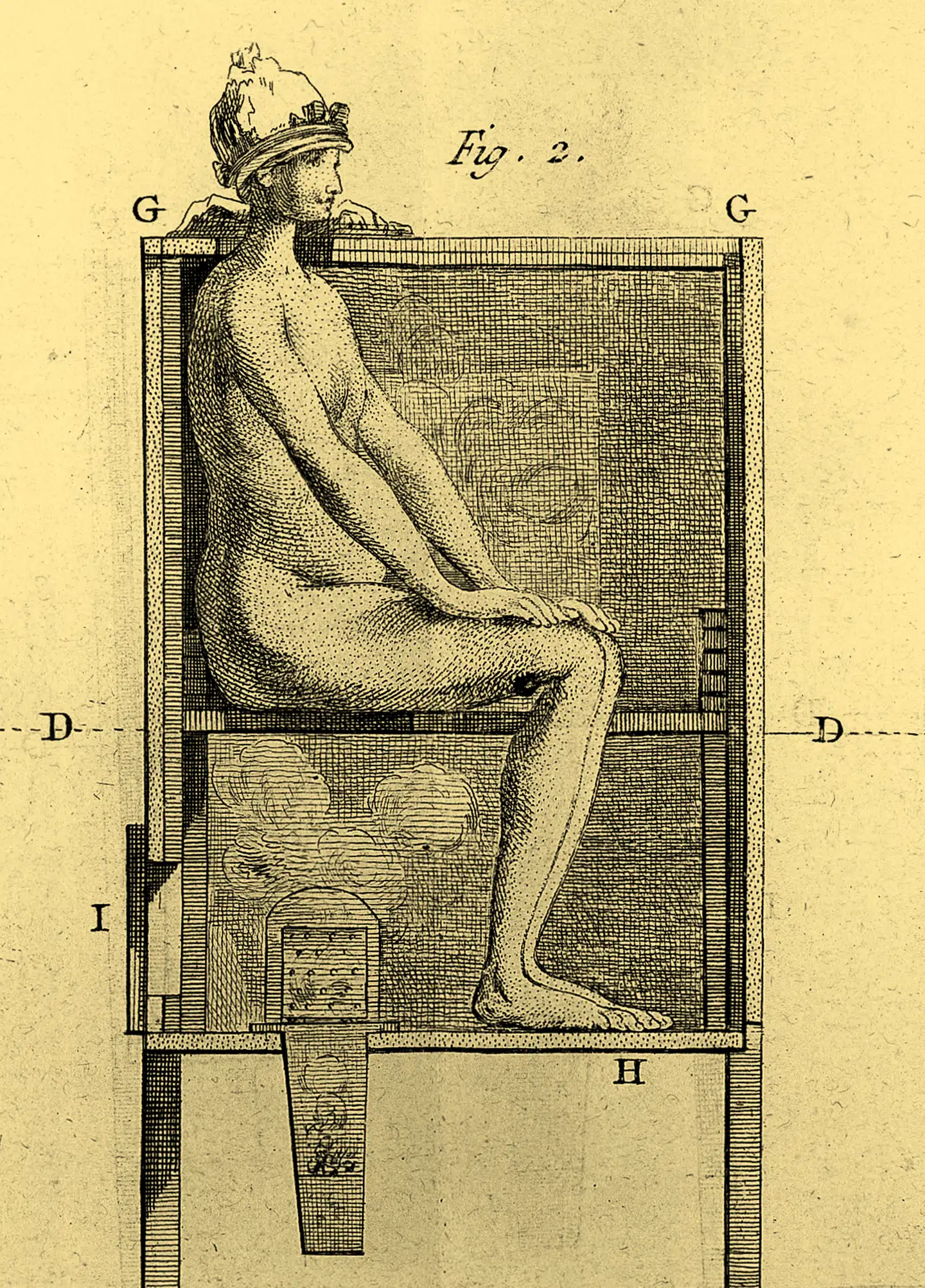 Patienten sad i en tønde med kun hovedet frit. I bunden blev en skål med et kviksølvmineral opvarmet, så kviksølvet satte sig som gråt støv i patientens hud, her på en illustration fra 1776.
Foto: Wellcome Library, London