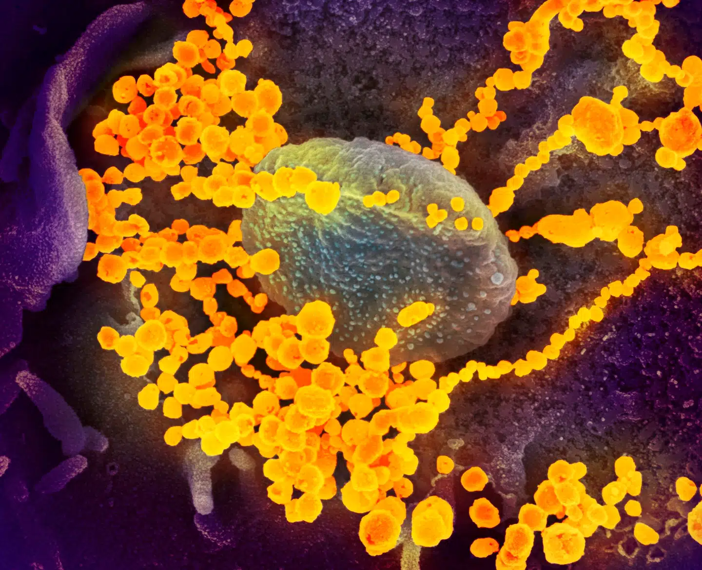 Den nye coronavirus (gule partikler) på vej ud af en celles overflade, set i et elektronmikroskop. Foto: National Institutes of Health/AFP, Scanpix