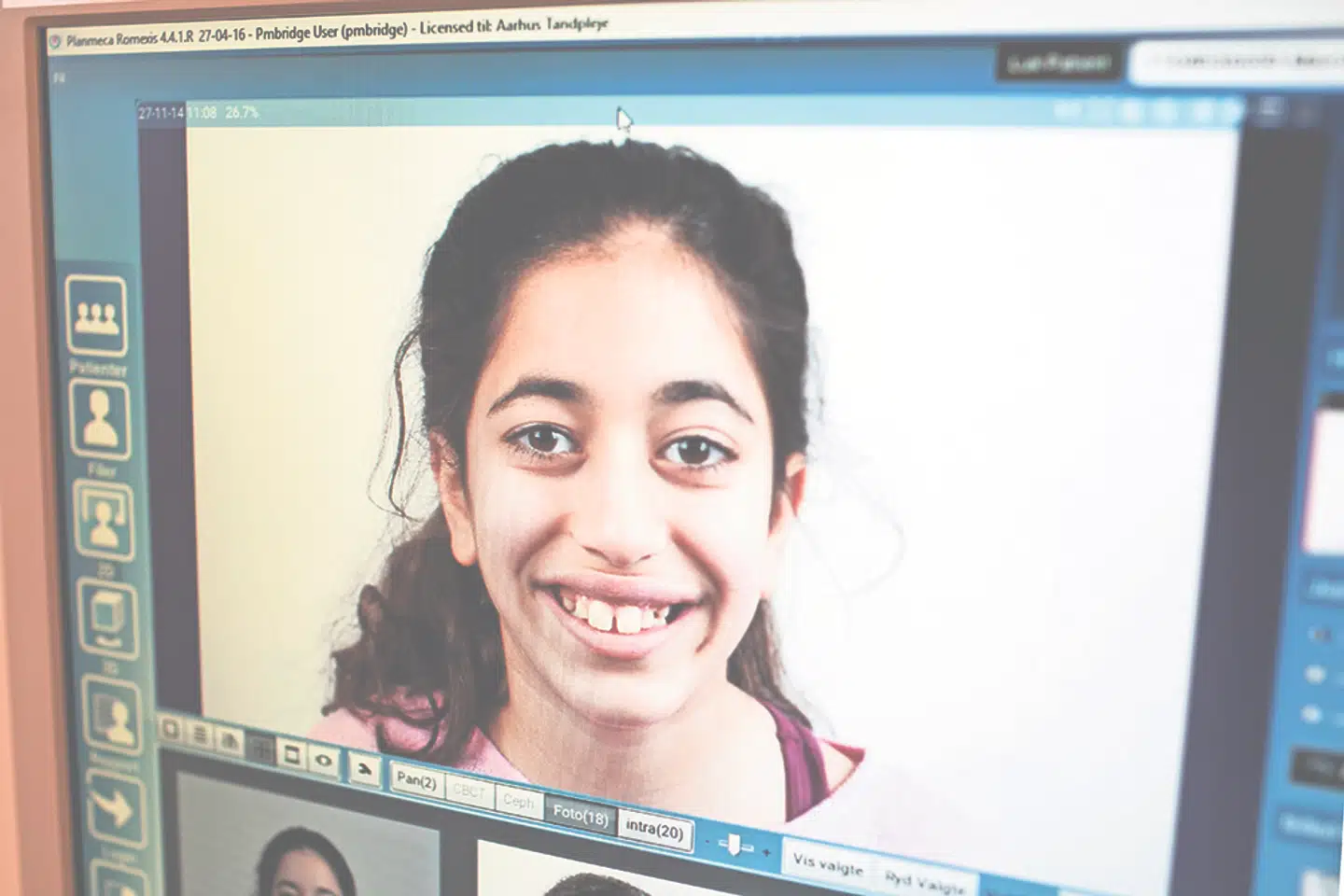 Tandklinikken har stadig fotos af Marta fra dengang, hun begyndte at få rettet tænder. På billedet er hun 11 år.