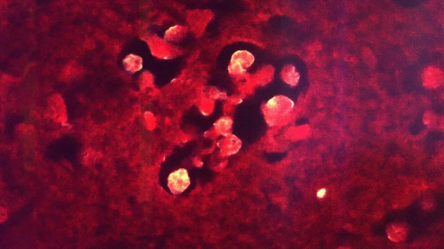 Her ses et mikrofotografi af et tilfælde med den sjældne hjerneinfektion kendt som primær amebisk meningoencephalitis på grund af Naegleria fowleri, som er en type hjernespisende amøbe. Billedet er fra det amerikanske Centers for Disease Control and Prevention (CDC).