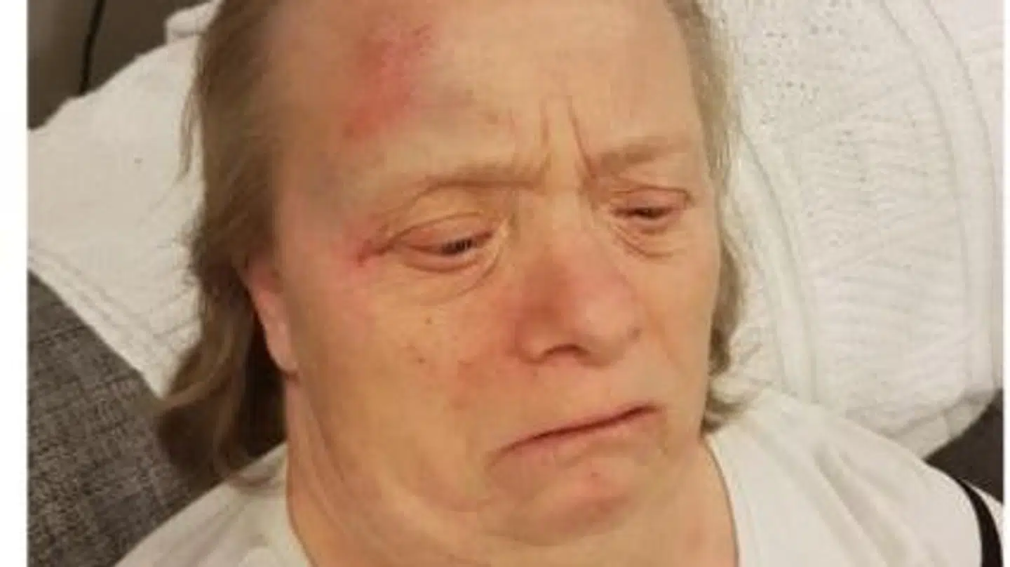 Gitte slog sig alvorligt efter et fald. Faldet skete formentlig på grund af såkaldt delir, voldsom forvirring, som opstod pga. ubehandlet blærebetændelse. Foto: Privat.