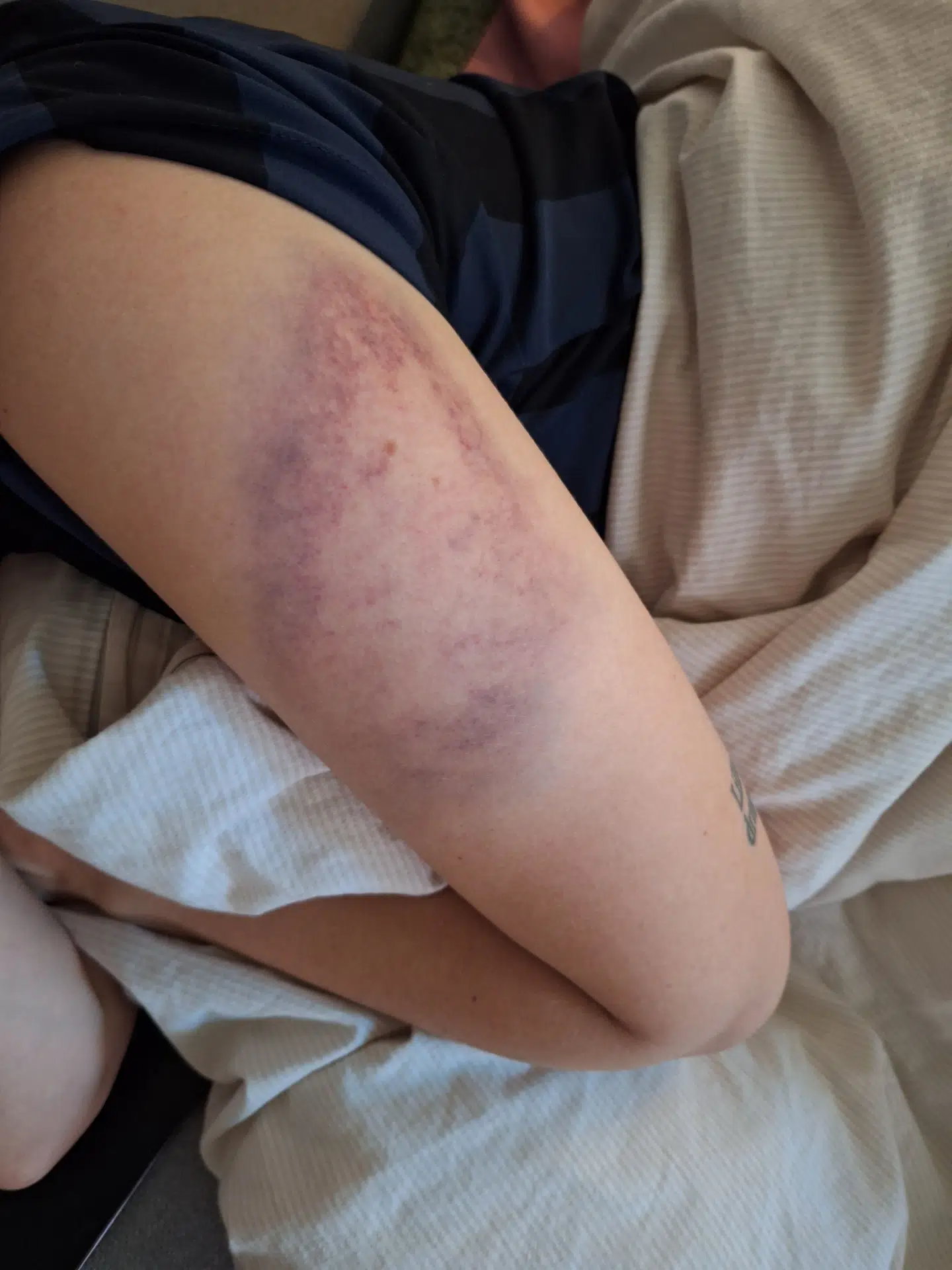 Her ses Aviaaja Schultz overarm efter det ene slag med kniplen