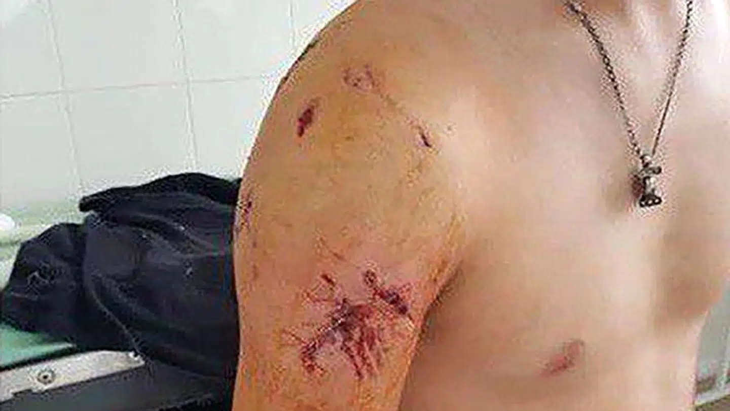 Skaderne på Nikolay Maksimovs skulder efter bjørnens angreb.