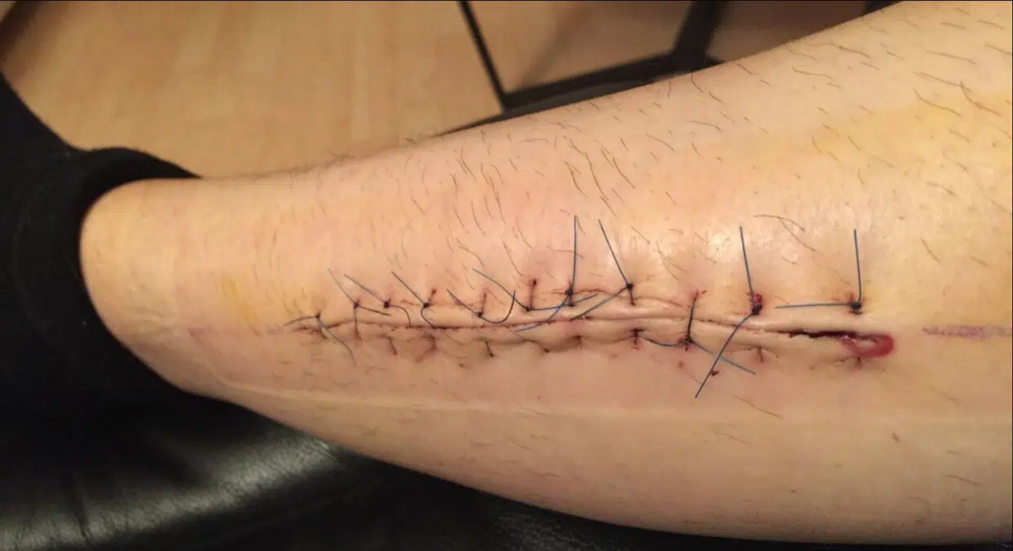 I forsøget på at redde Karinas ben foretog lægerne på et tidspunkt en såkaldt spaltning af musklerne i læggen.