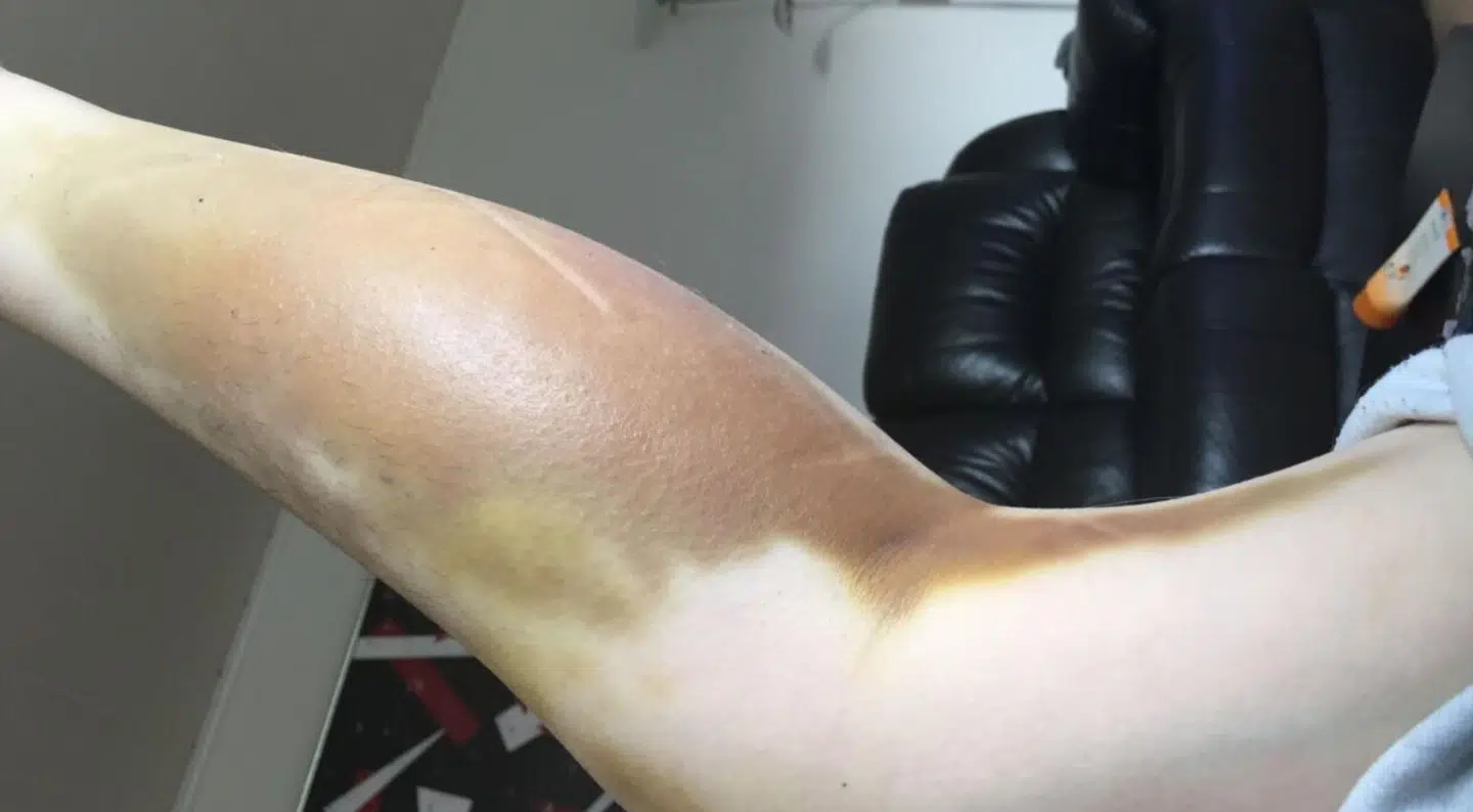 Efter en operation for en korsbåndsskade fik Karina en blodansamling i benet. Til at begynde med ville lægerne ikke gøre noget ved det, og det fik alvorlige konsekvenser for Karinas ben.